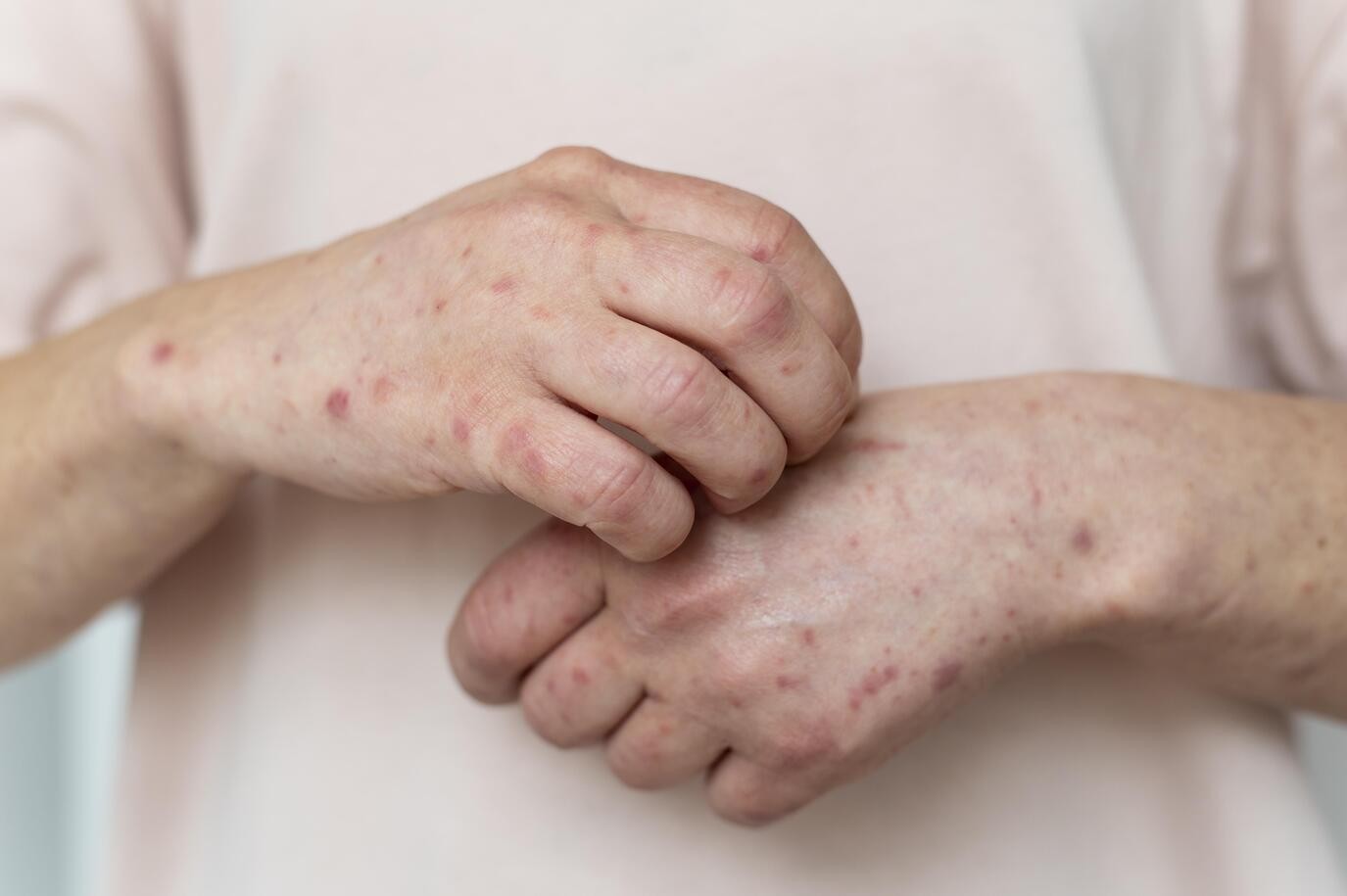 Ten Presentation Rash Hospital presentations: Rash